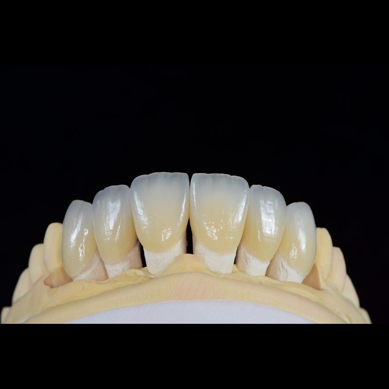 Feldspathic Porcelain Veneers