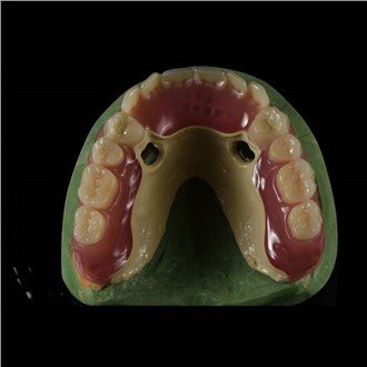 Peek Framework Prothese