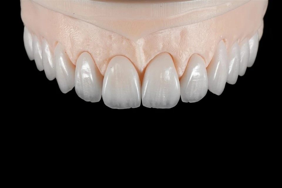 Feldspatveneers mit inzisaler Transluzenz