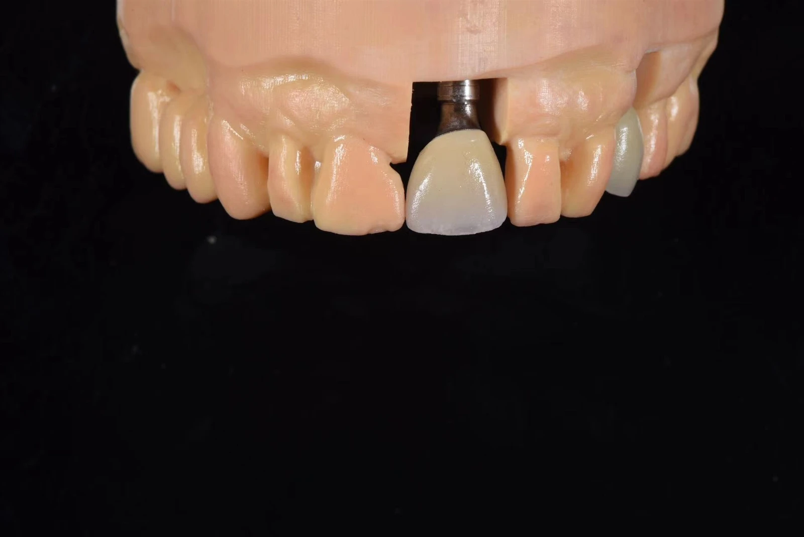 Zirconia anterior implant crown with customized emergence profile Zirconia anterior implant crown with customized emergence profile