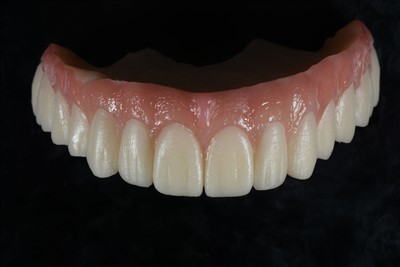 Temporäre Krone aus Acrylharz