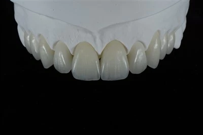 Feldspatveneers für verfärbte Zähne